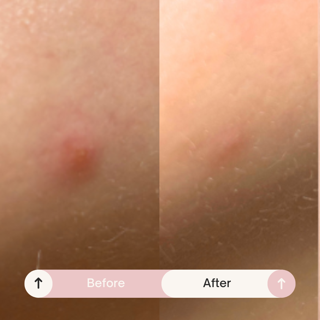 Spotted Daytime - Invisible Hydrocolloid Patches